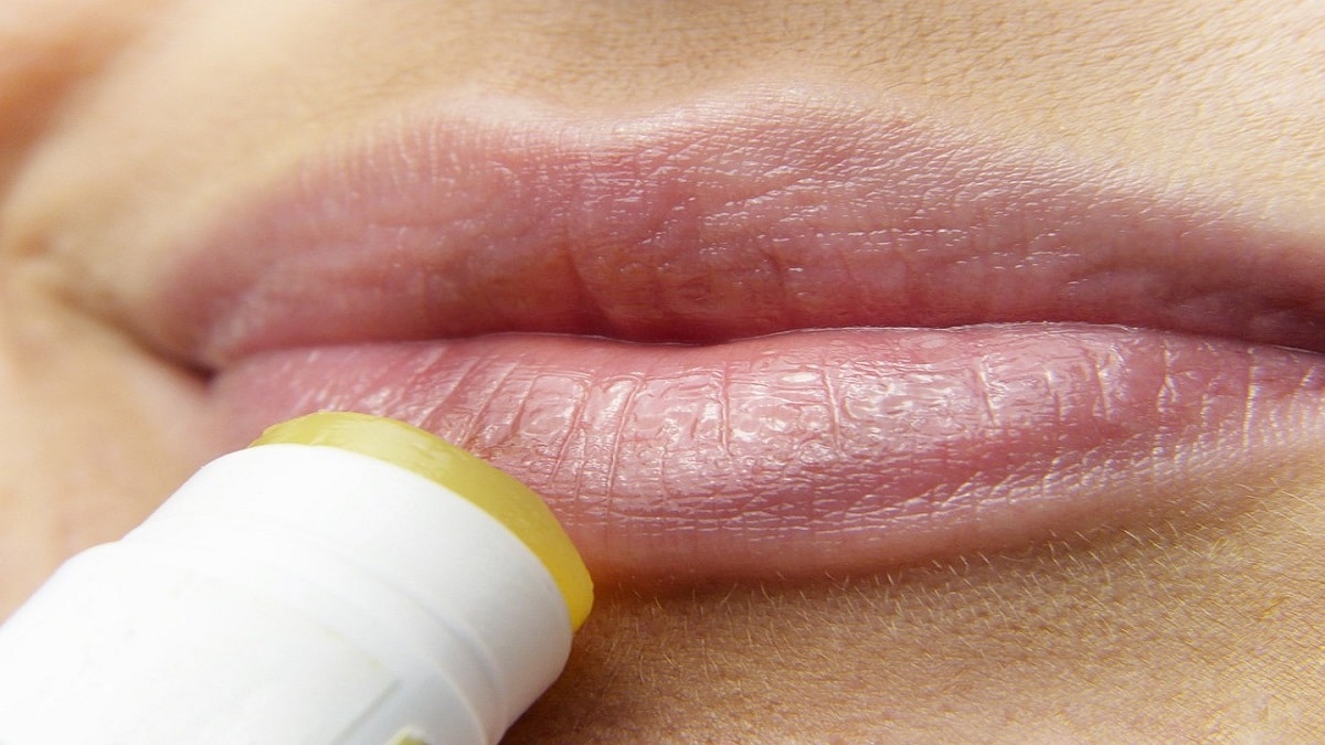 Herpes labiale: come prevenirlo e curarlo naturalmente